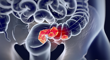 Colorectal Cancer Screening Colorectal Cancer Screening