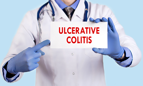 Ulcerative Colitis Ulcerative Colitis